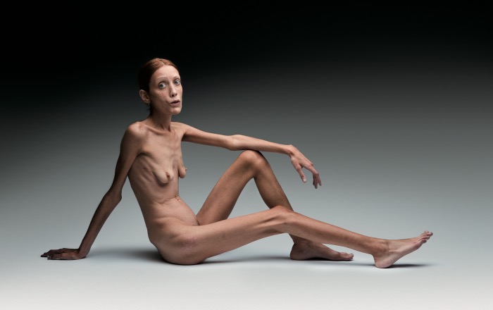 Oliviero Toscani | No Anorexia